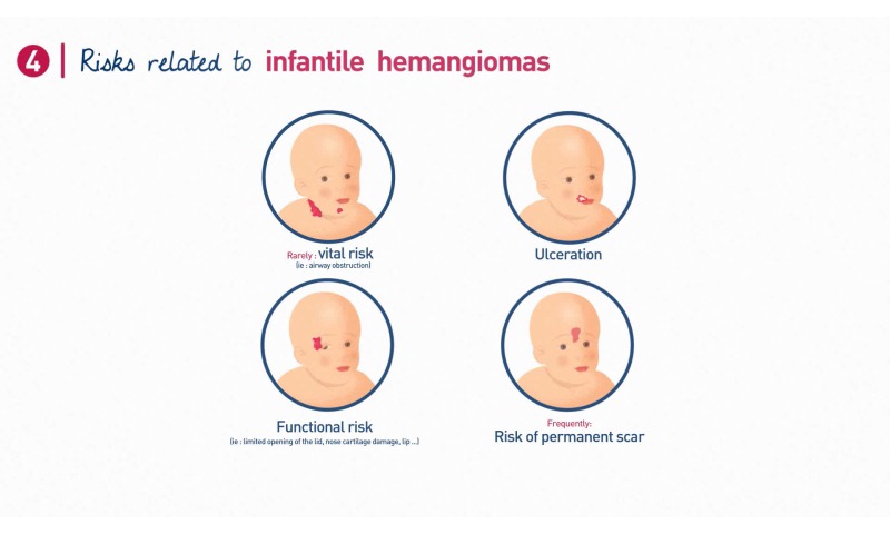 L’emangioma infantile regredisce spontaneamente?