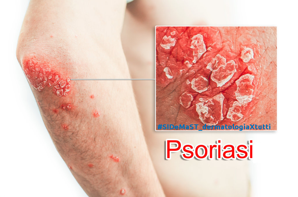 La psoriasi è la malattia dei sani