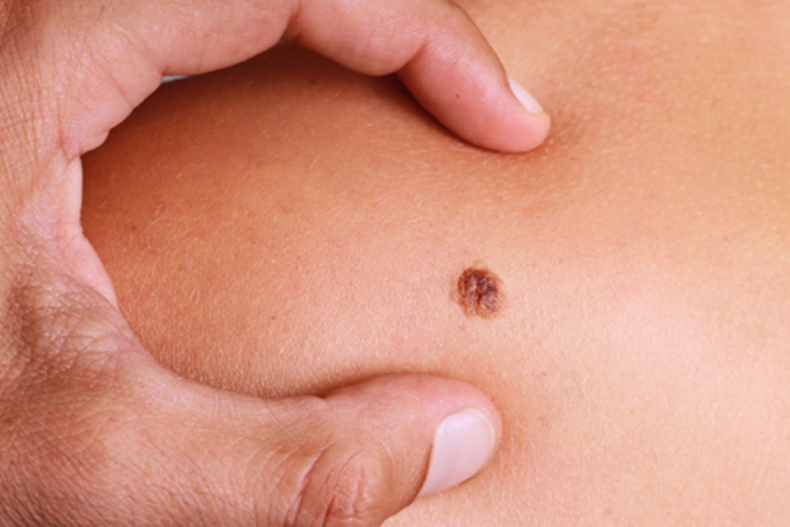 Comportamenti da evitare e avanzamenti della ricerca cause melanoma