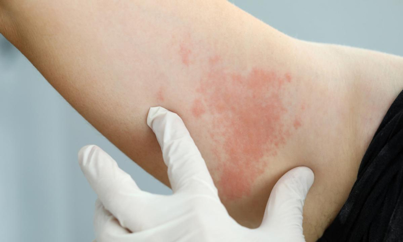 C'è un collegamento vaccino covid e problematiche dermatologiche?