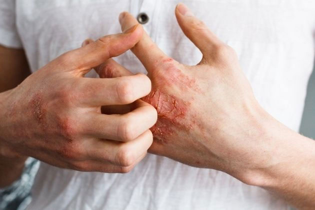 Quale collegamento e possibilità di trattamento, psoriasi ed artrite psoriasica