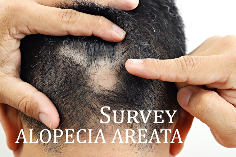 Survey Alopecia Areata