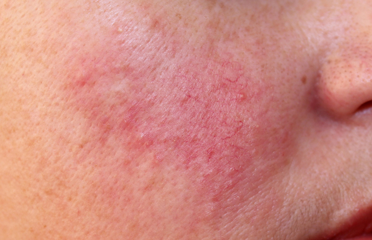 Una "rosacea" per tre