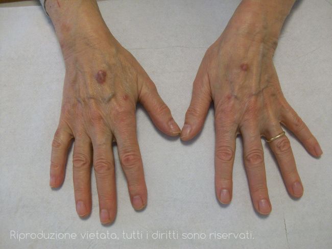 Placche violacee al dorso delle mani di due pazienti